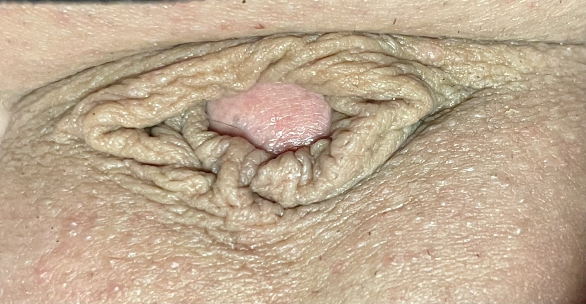 Micropenis close up #13