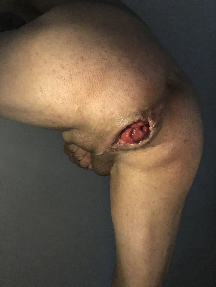 my anal prolapse is changing incredibly #7
