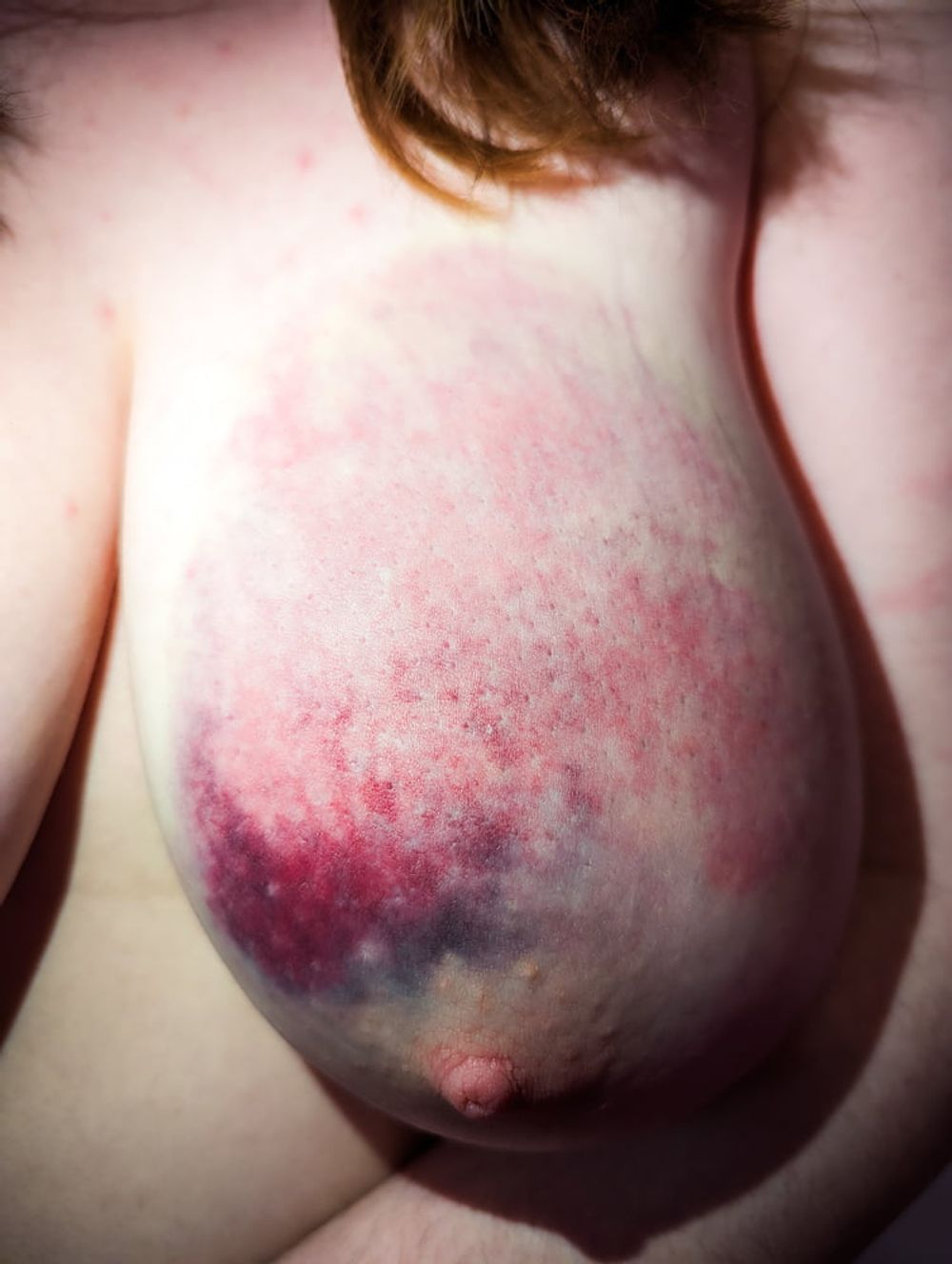 My bruised tits after a rough BDSM session #4