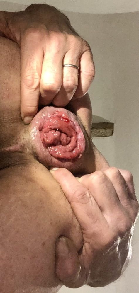 anal dilation after big insertion #21