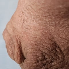Micro Penis