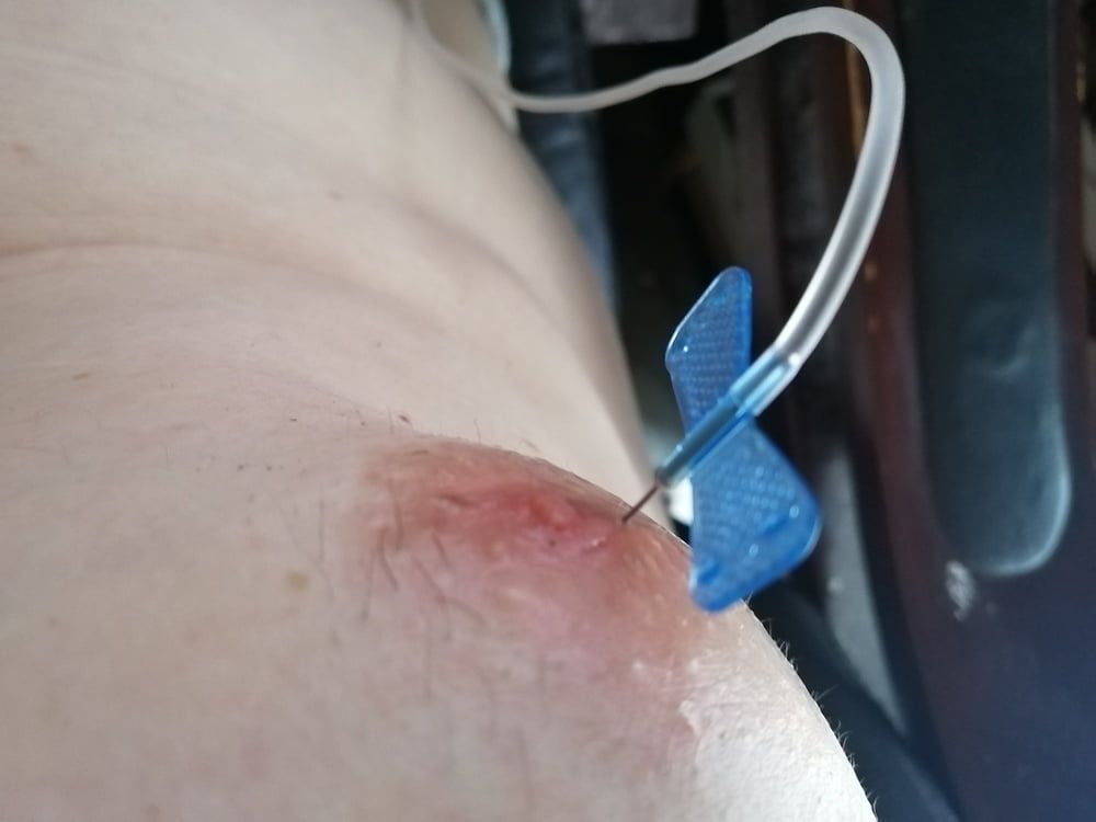 saline infusion scrotum - more as 2 l #31