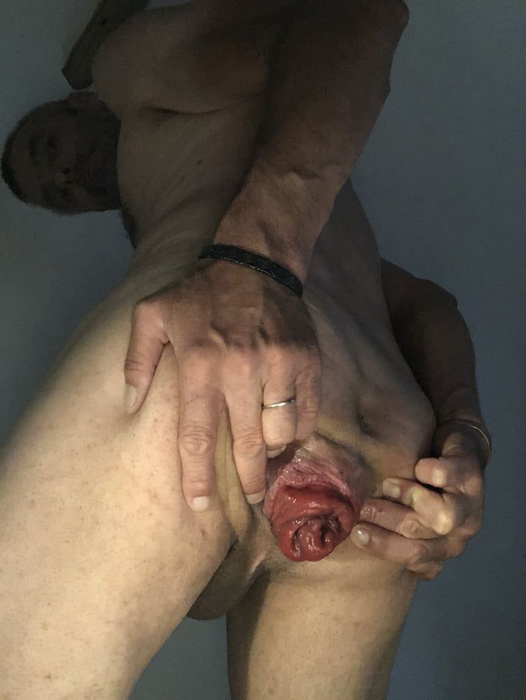 my anal prolapse is changing incredibly #9
