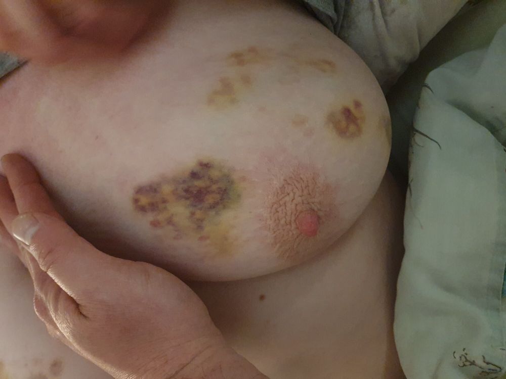 Mrs. Kink&#039;s Bruised Tits #7