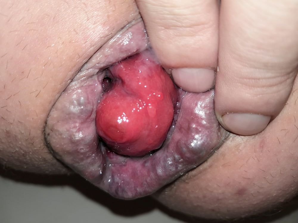 prolapse #6