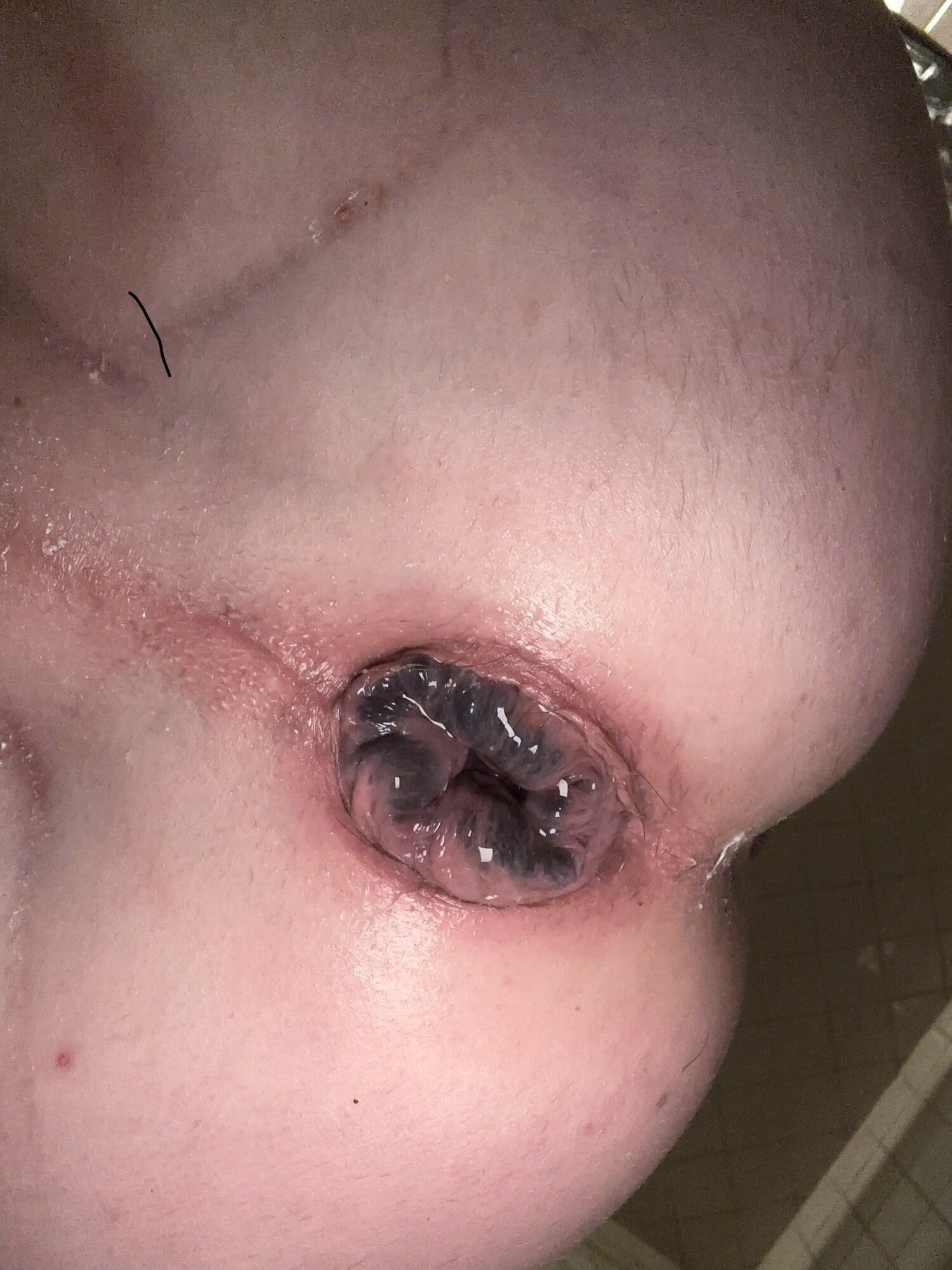 My used gaping black and blue hole! #2