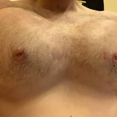 Saline breast