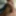 Foreskin overhang and loose