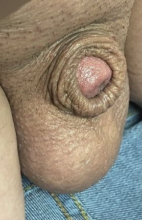 Inverted tiny penis