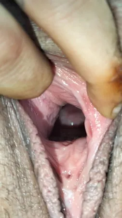 cum covered cervix         