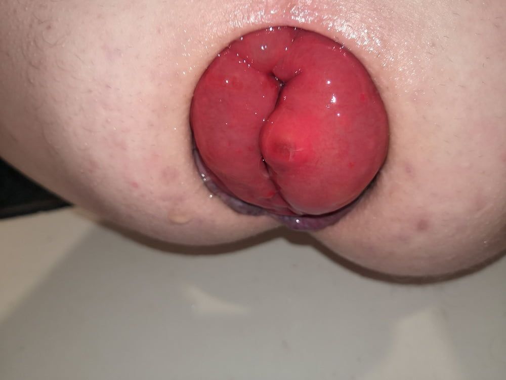 prolapse #9