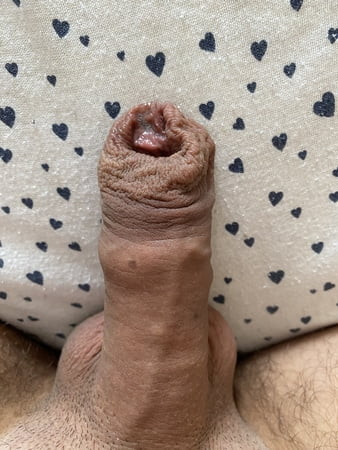 Foreskin after stretching