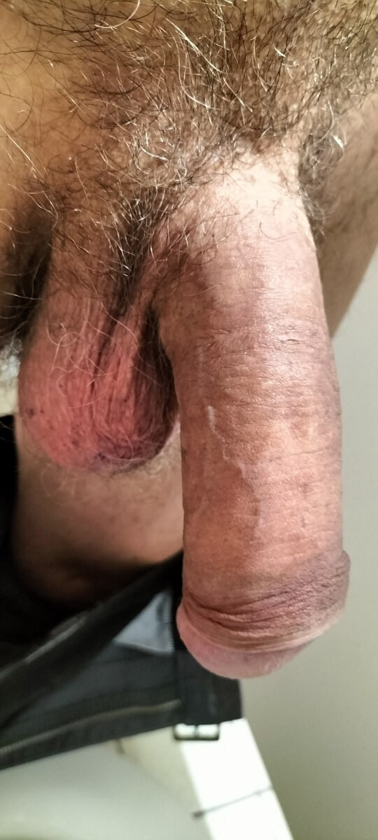 My Hypospadias