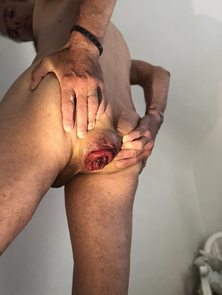 dilatation prolapse anal #6