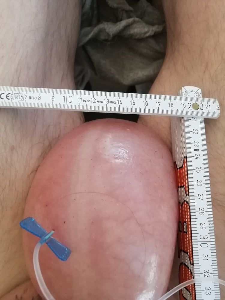 saline infusion scrotum - more as 2 l #18