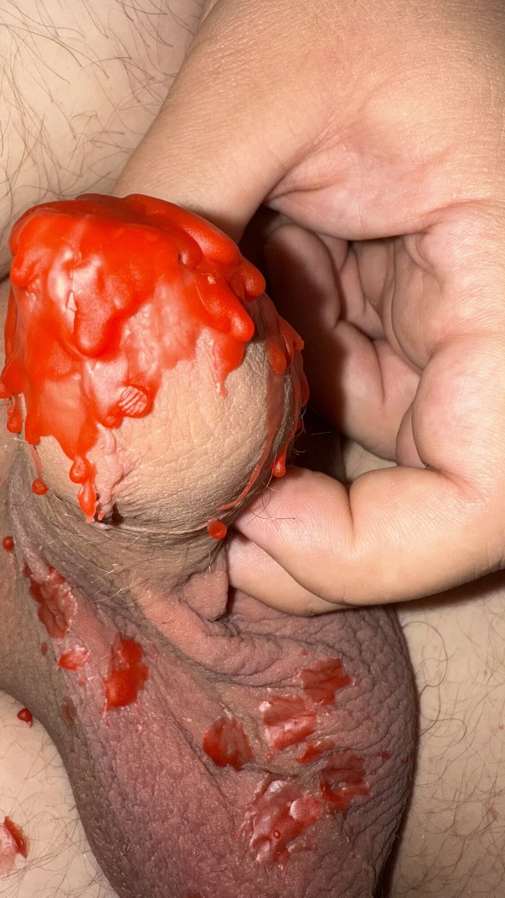foreskin closed with candle wax #6