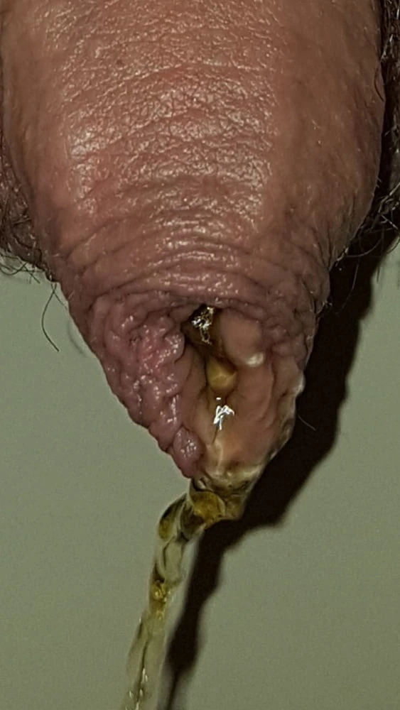 My foreskin #4