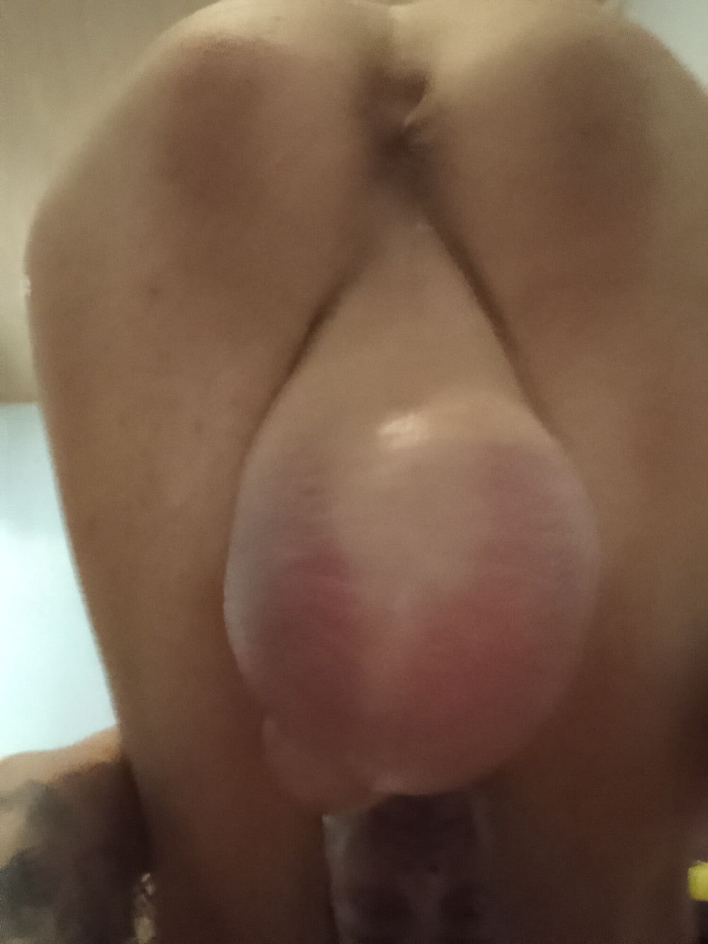 Finished results of today's 2L .9 saline fill  #7