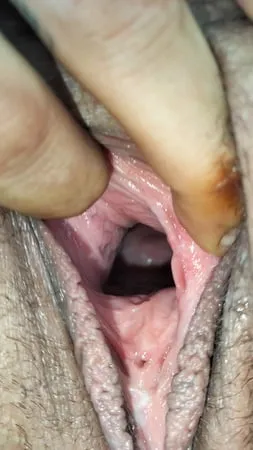 cum covered cervix         