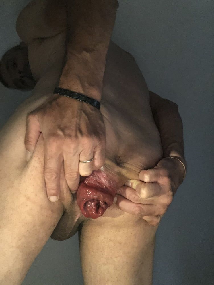 my anal prolapse is changing incredibly #8