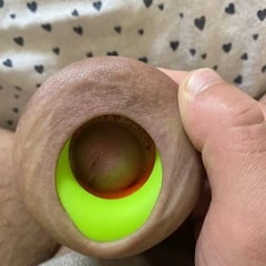 Foreskin extreme stretching with ring