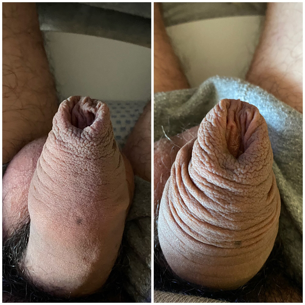Foreskin stretching