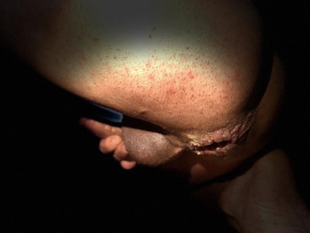 Dilatation anal  #4