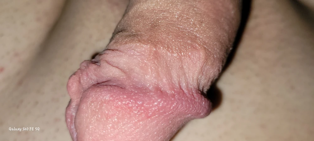 Circ penis april25 #15