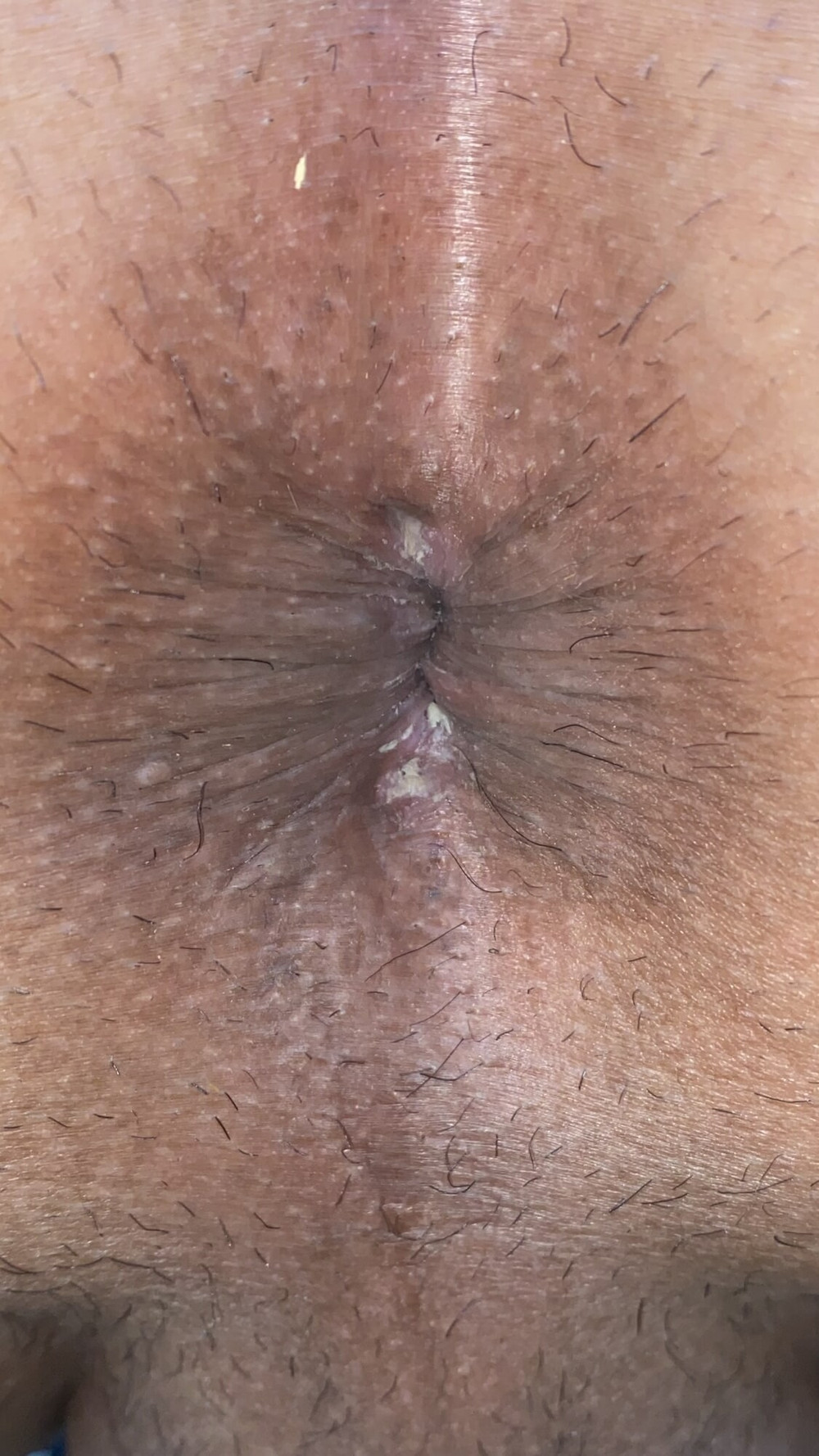 Close-up of a man&#039;s anus #11