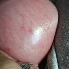saline-infusion in scrotum first try 1 liter