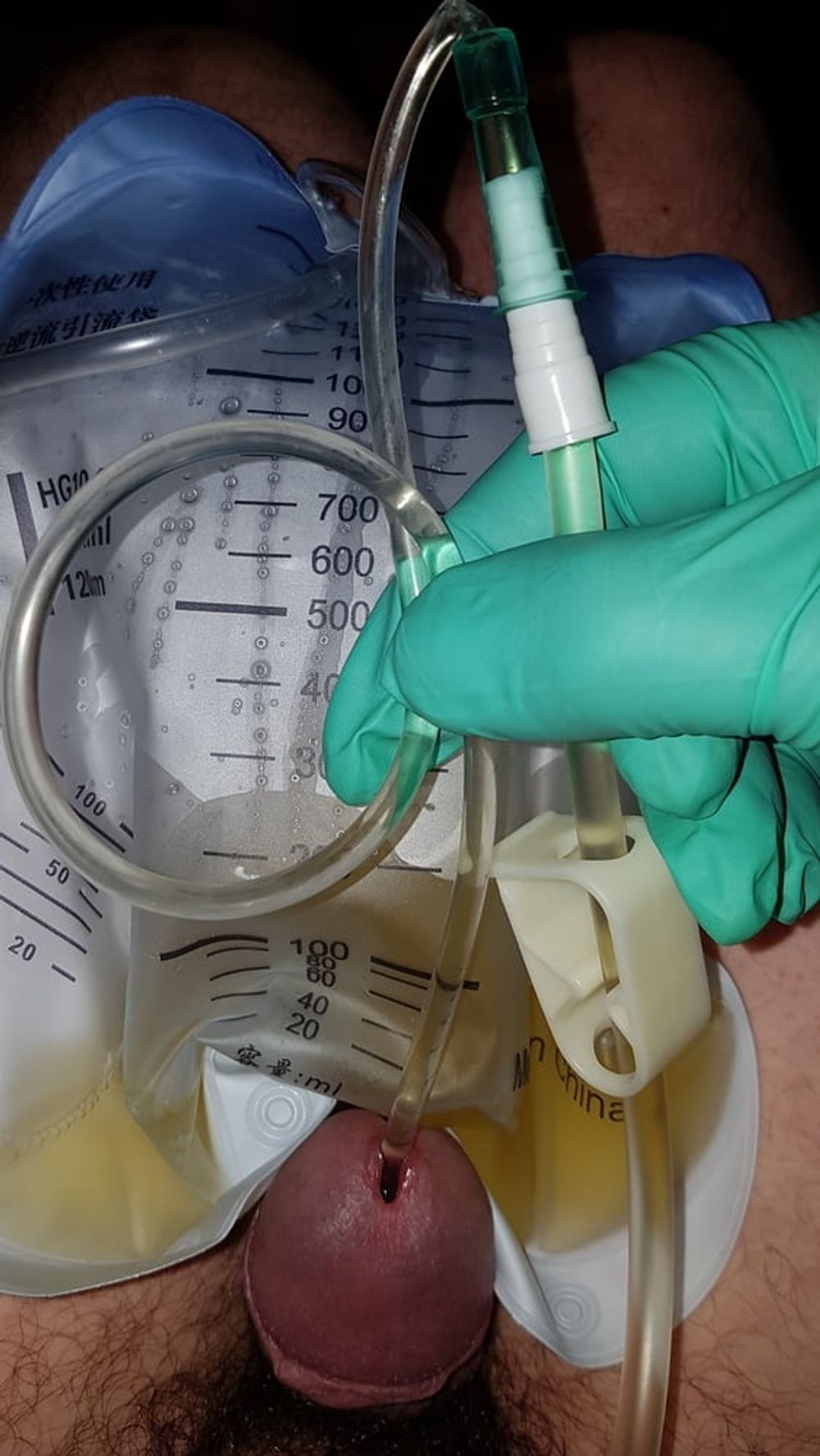 Catheter sounding with my urine 2 #12