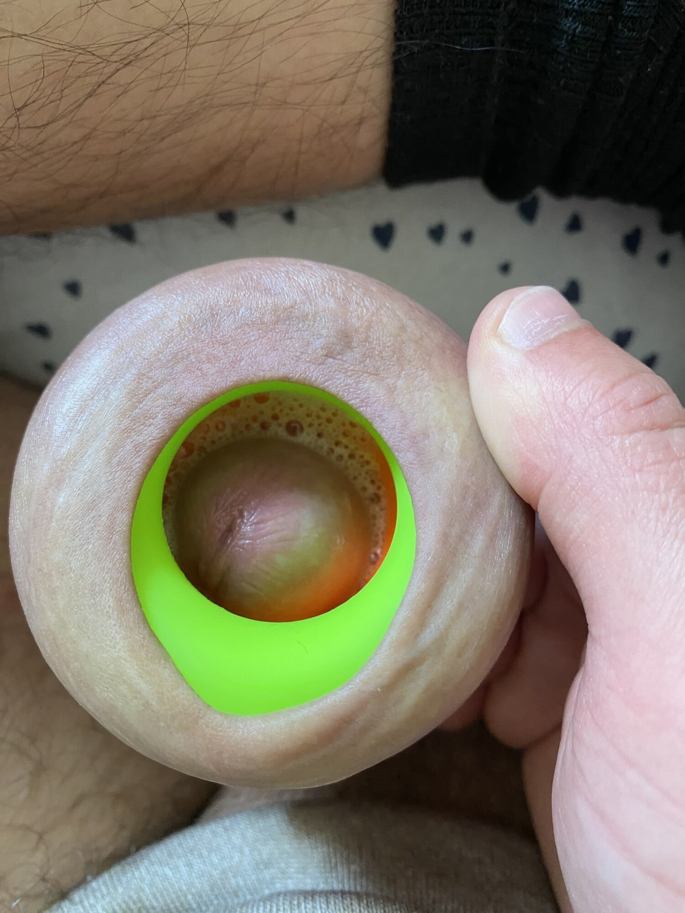 Foreskin extreme stretching with ring #5