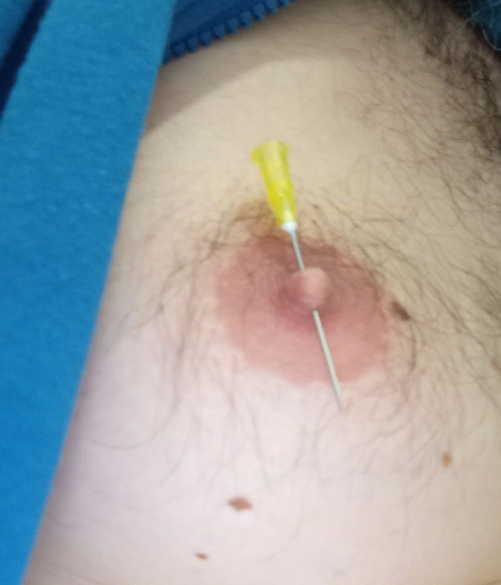 Needle torture for a poor boy #2