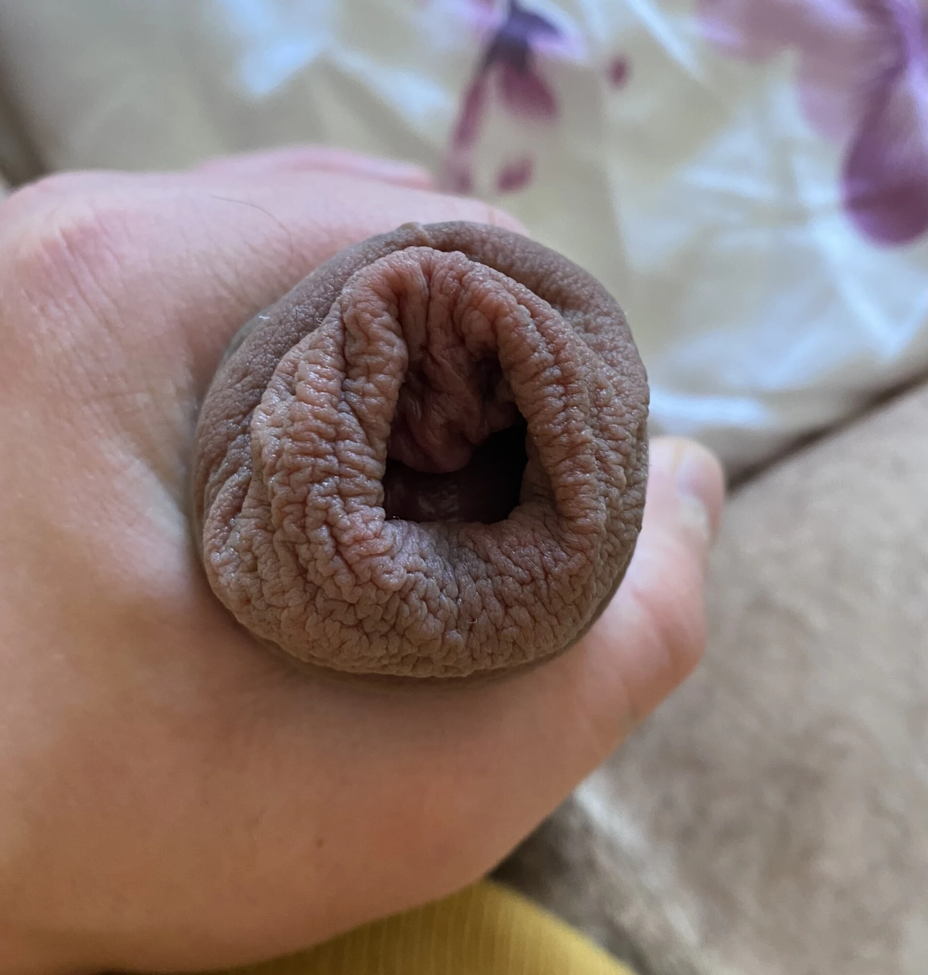 Extreme stretching foreskin