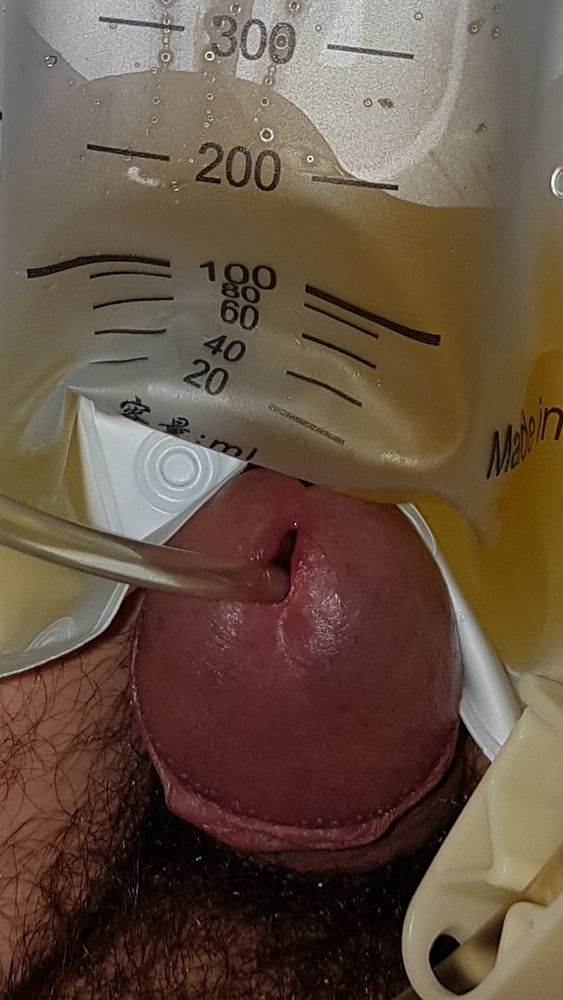 Catheter sounding with my urine 2 #17