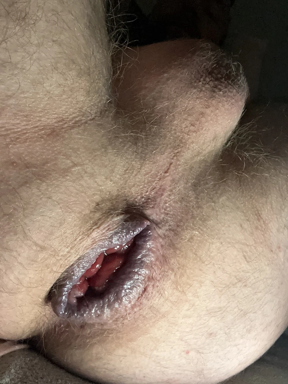Anus #2