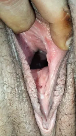 cum covered cervix         