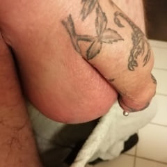 saline-infusion in scrotum - second 2 liter