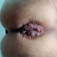 My anus