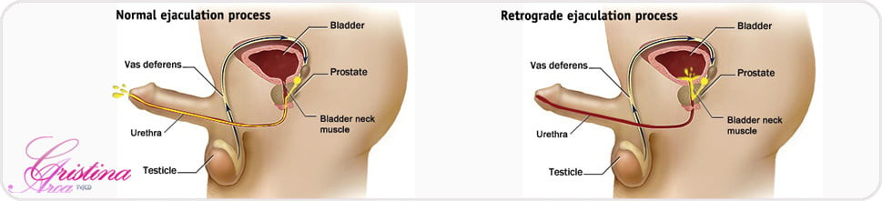 The fucked retrograde ejaculation...