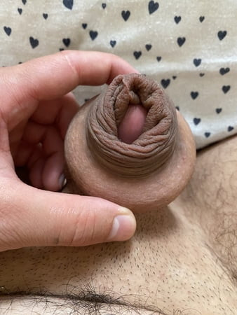 Foreskin extending with donut ring