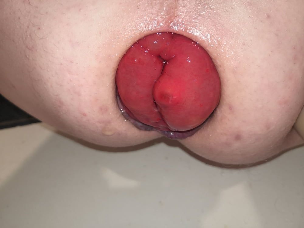 prolapse #8