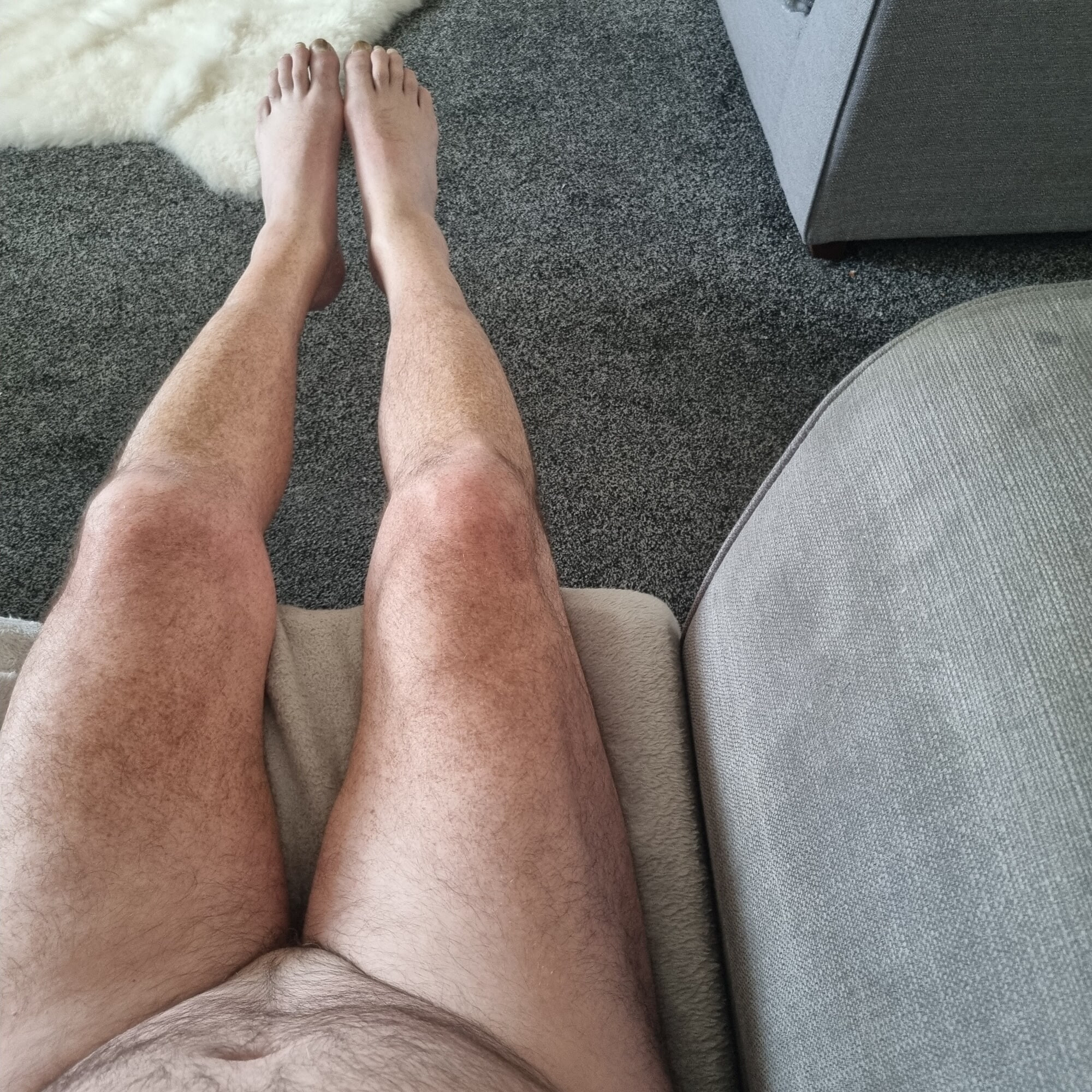 losing my penis