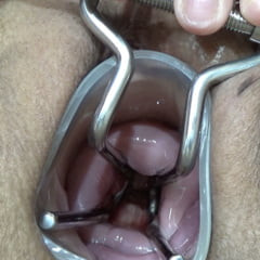 Cervix Gallery