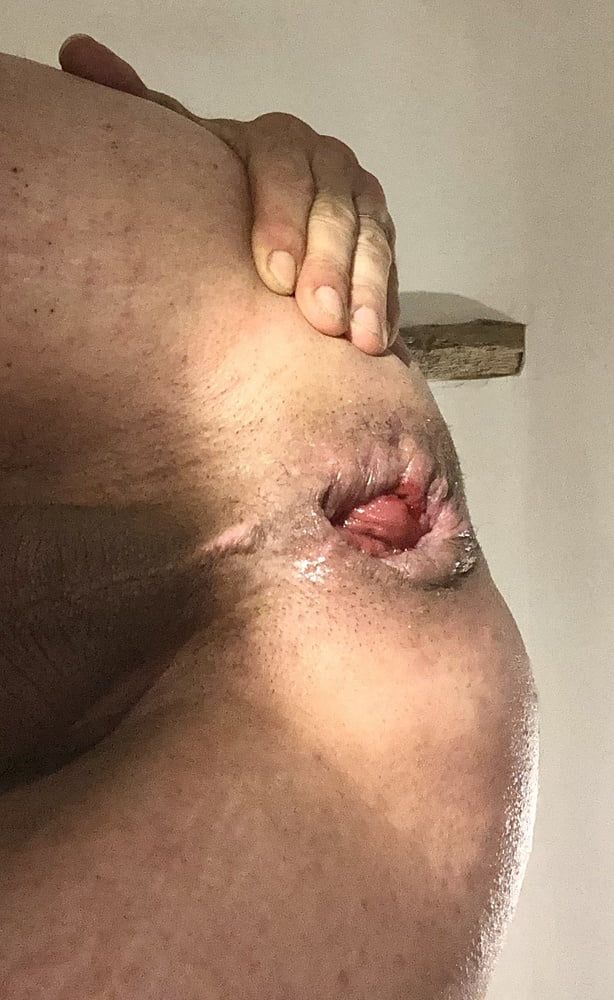 anal dilation after big insertion #22