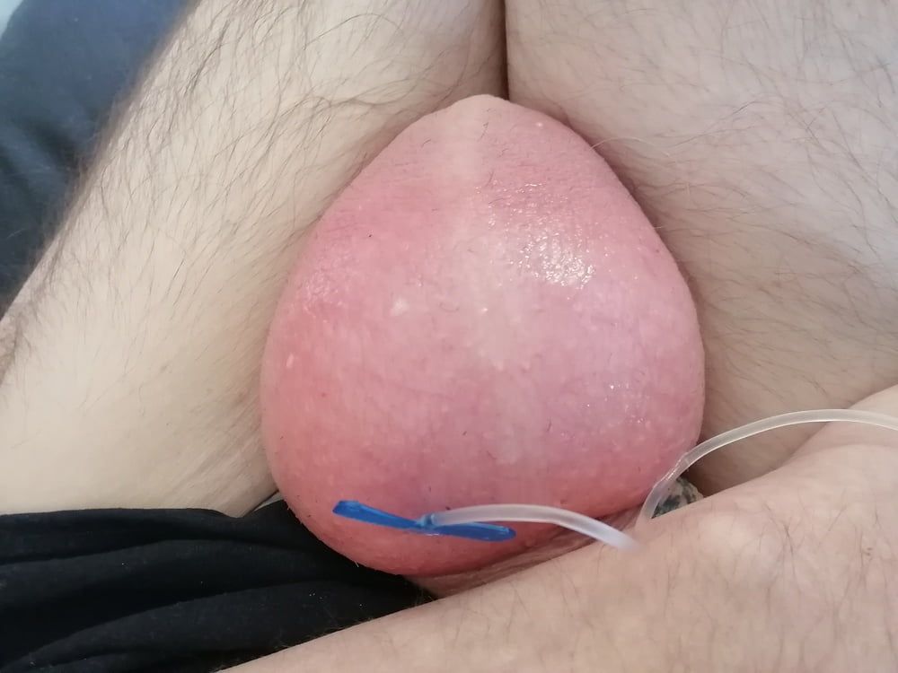 saline-infusion in scrotum first try 1 liter #11