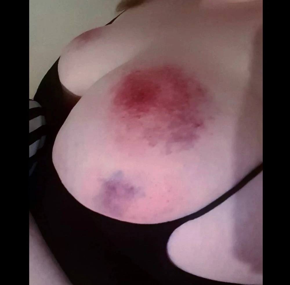 Bruised Baby #47