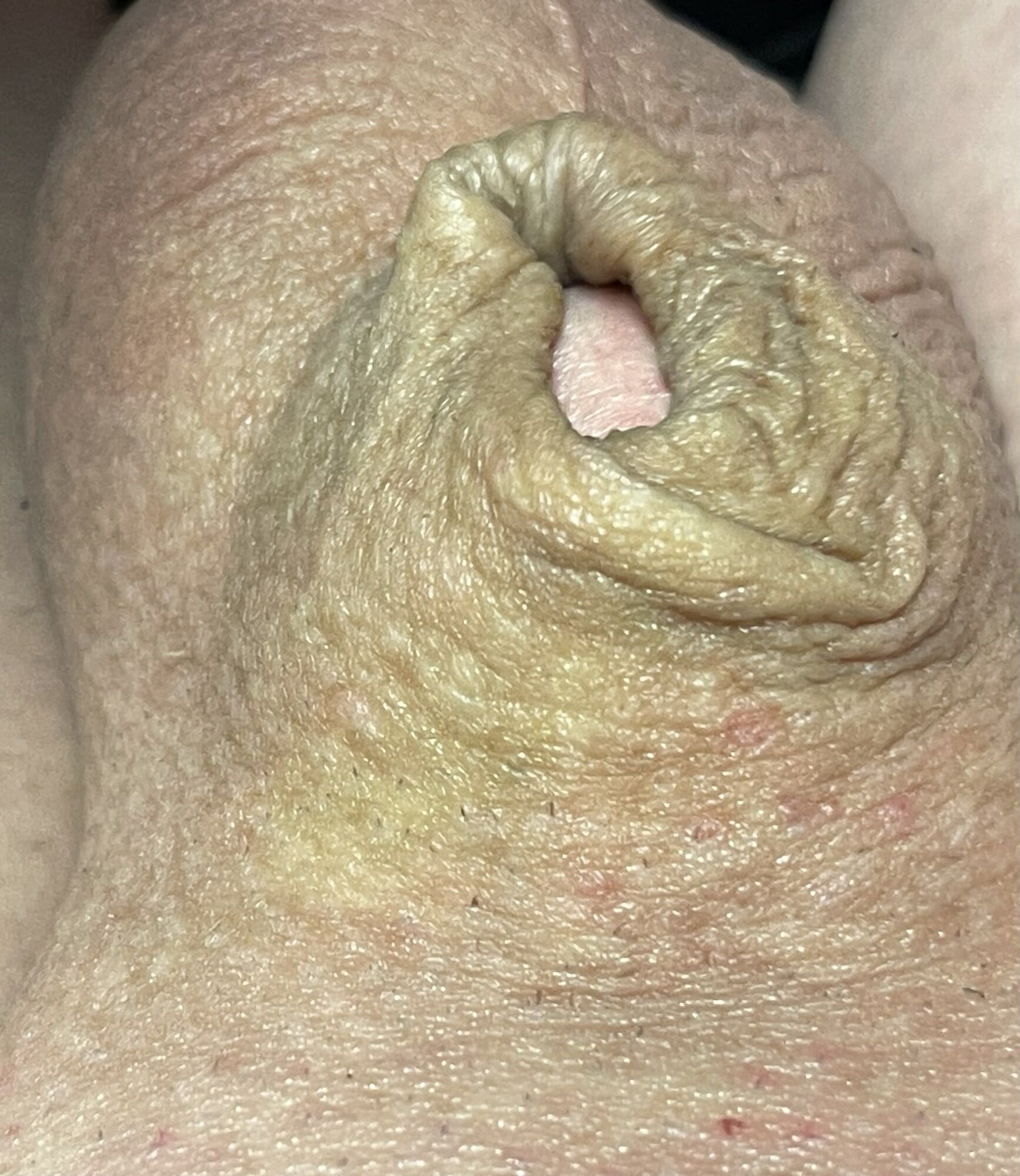 Micropenis close up #9