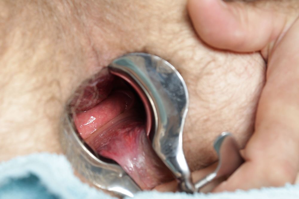 anal speculum #7