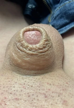 inverted tiny penis         